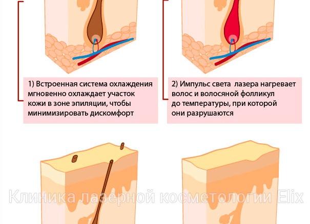 Как работает лазерная эпиляция и что происходит после первой процедуры