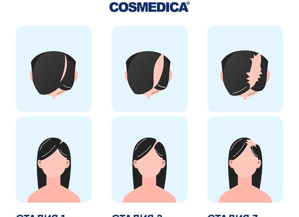 Как остановить выпадение волос: когда проблема в коже головы