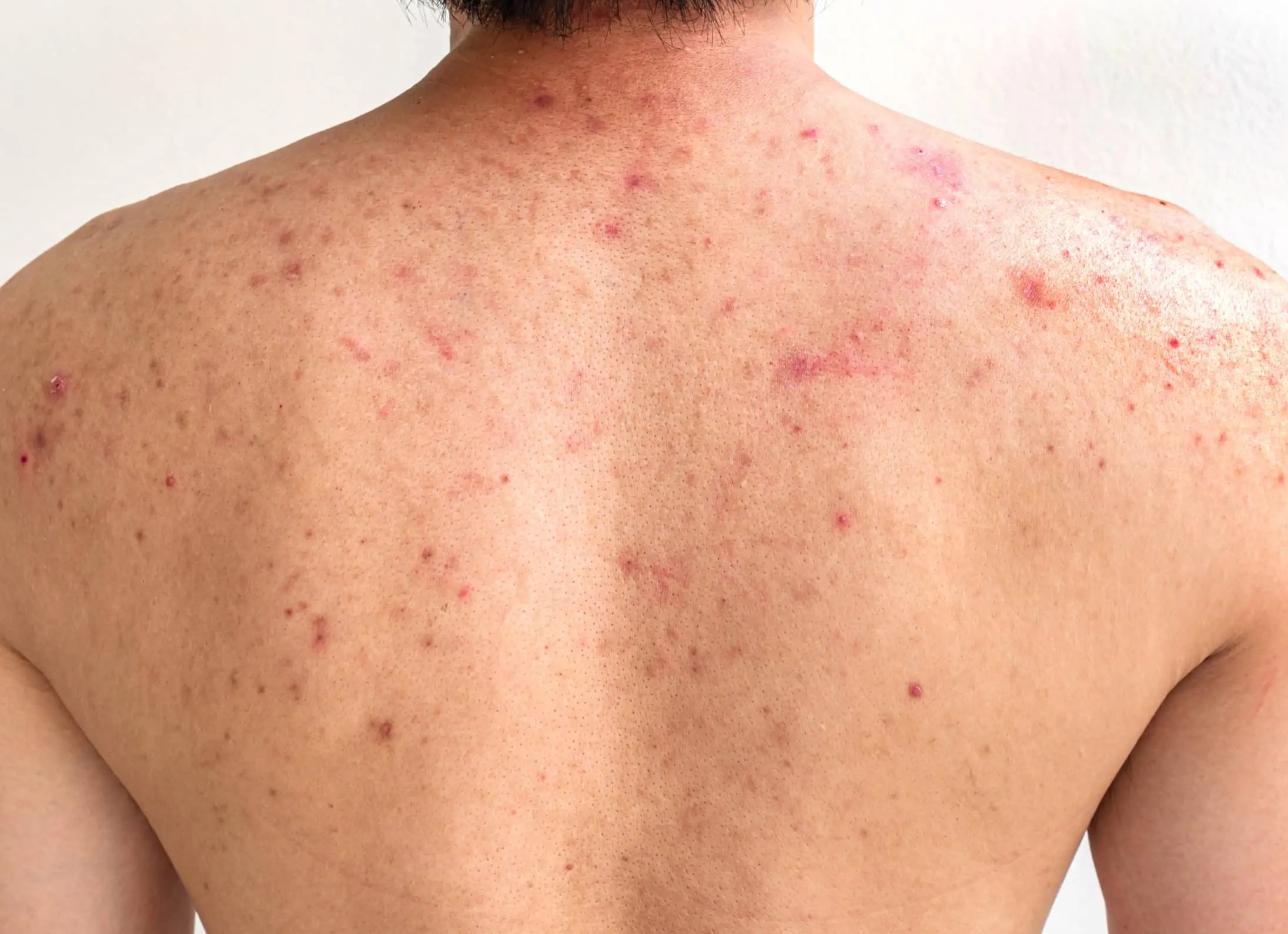 Как убрать прыщи на спине, плечах, груди: эффективные методы и советы